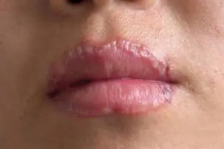 慢性接触性唇炎白斑图