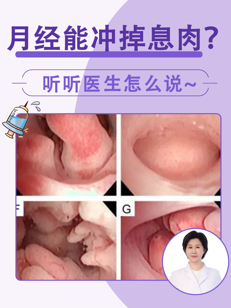 月经能冲掉息肉?听听医生怎么说~