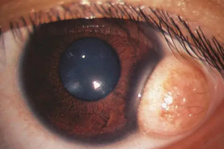 角膜鳞状上皮细胞癌肉球图