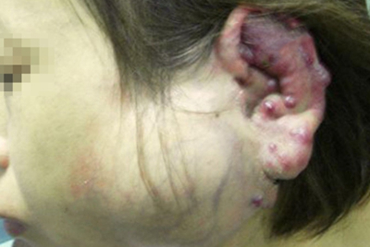 血管瘤出现丘疹图