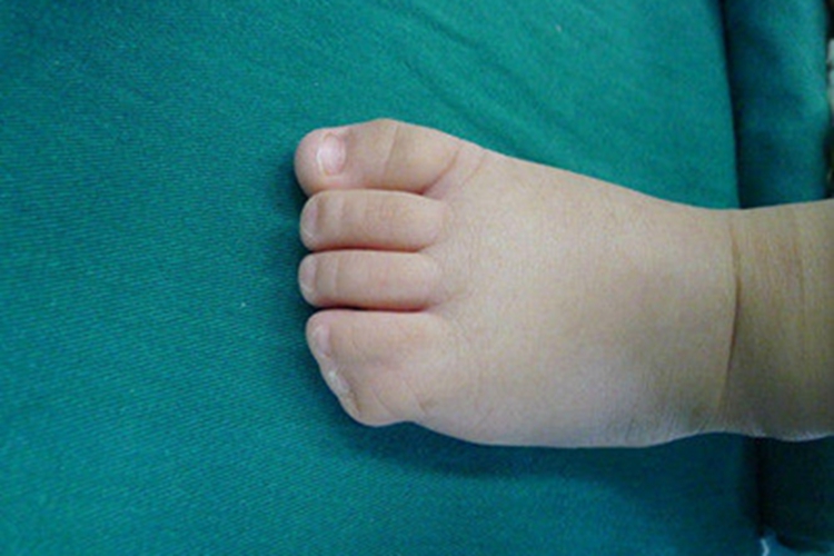 并趾畸形脚趾粘连在一起图