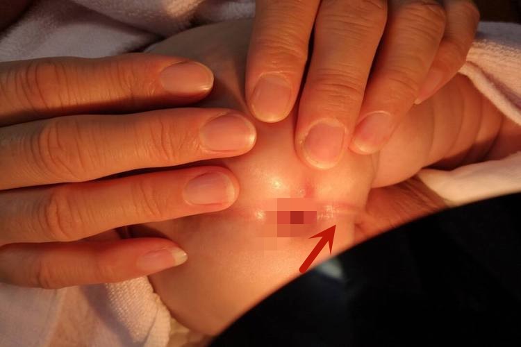 婴儿肛周脓肿刀口图