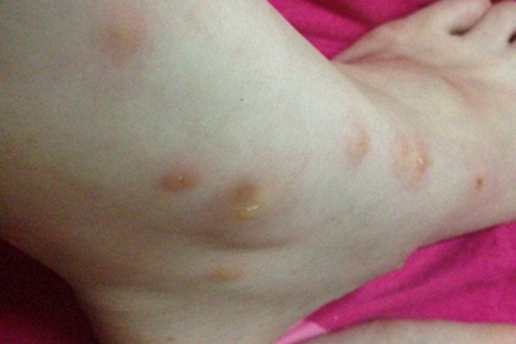 跳蚤叮咬脚踝水疱图 跳蚤叮咬脚踝水疱图