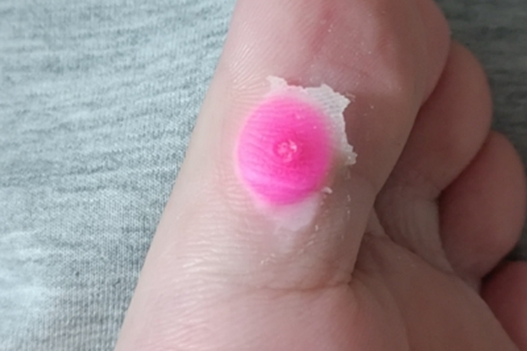 硬鸡眼脚趾症状图