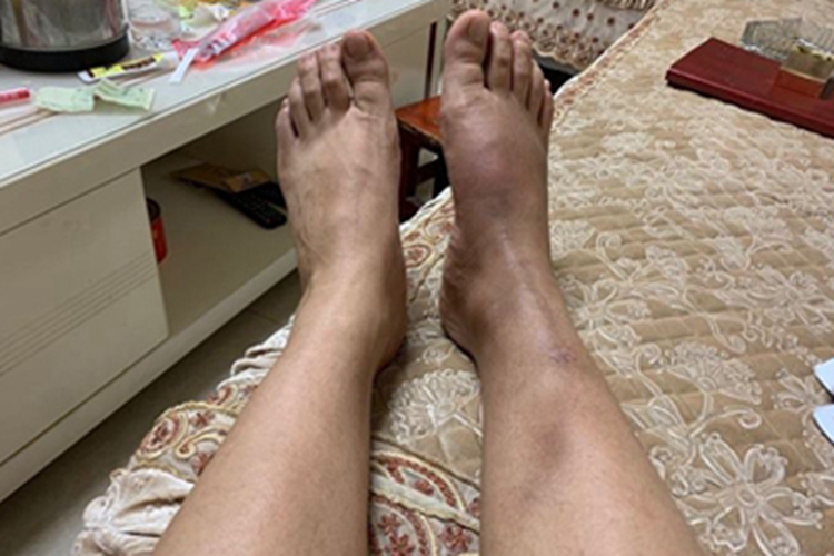 硬化性脂膜炎脚背皮肤发黑图