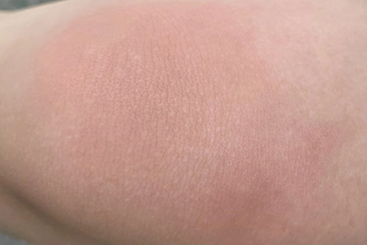 虫咬皮炎膝盖症状图 虫咬皮炎膝盖症状图