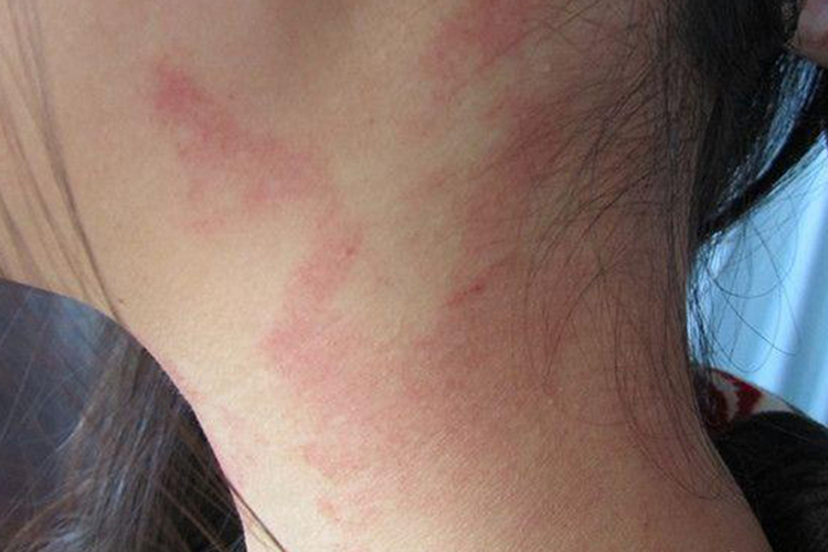 光毒性接触性皮炎颈部红斑图