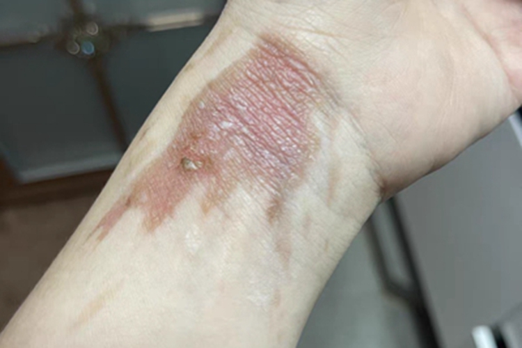 Ⅰ度烧伤症状图 Ⅰ度烧伤症状图