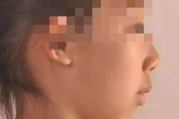 嘴呼吸造成嘴凸图