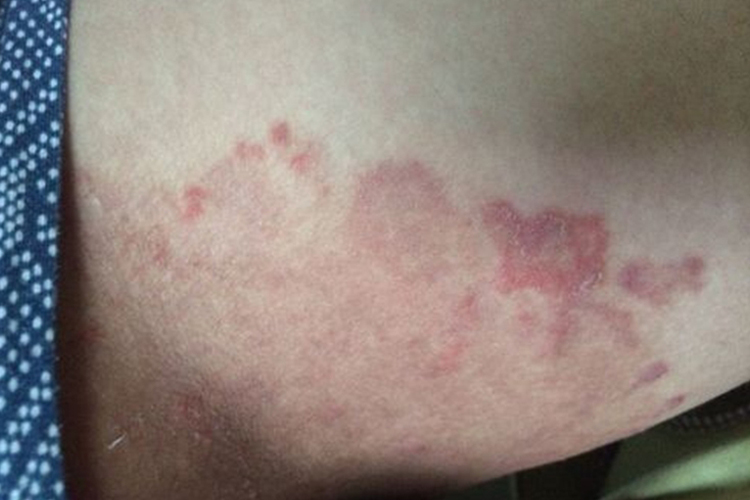 大腿根部股癣图