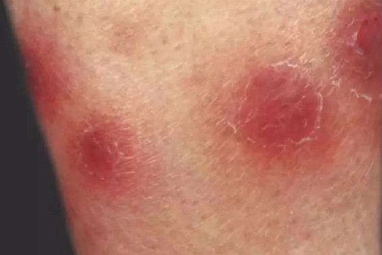 肺结核引起的皮肤病图