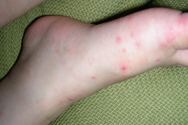 手足口病初期脚部皮疹图