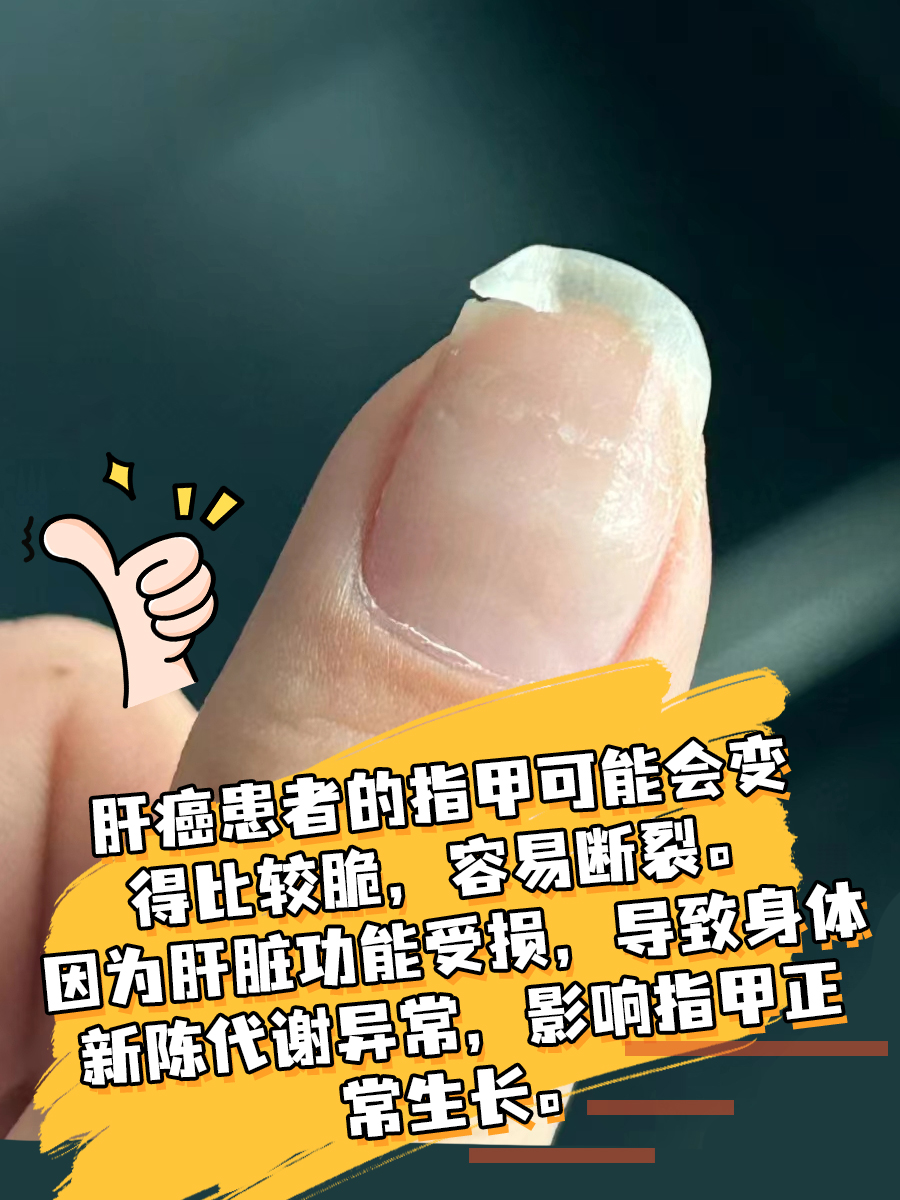 身体有肝癌，指甲先知！