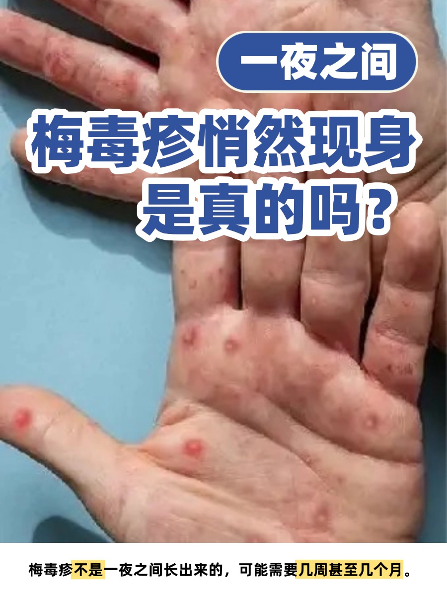 一夜之间，梅毒疹悄然现身是真的吗？