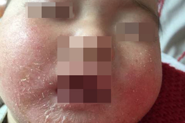 婴儿期特应性皮炎裂纹图