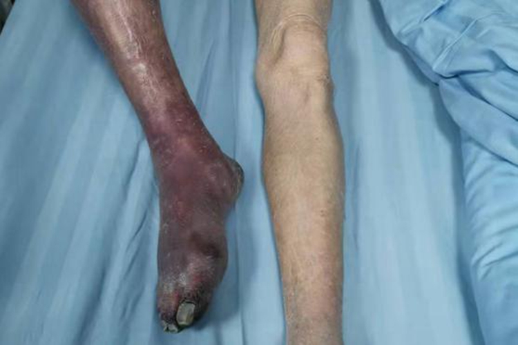 肢末端坏疽图