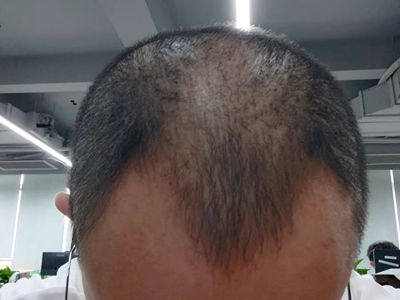 雄激素性脱发额头两边脱发图