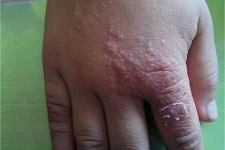 急性湿疹手部脱屑图 急性湿疹手部脱屑图