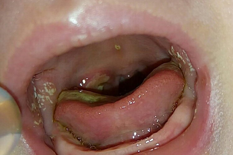 鹅口疮口腔后壁发炎图