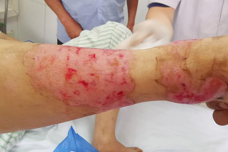 脱漆剂烧伤皮肤图