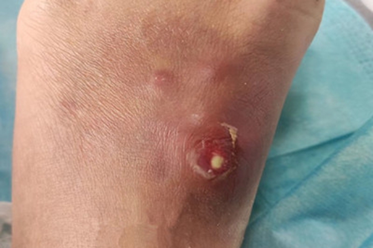 痈脚背有肿块流脓图