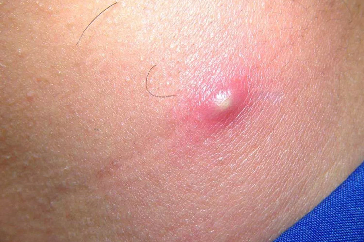 表浅型毛囊炎图