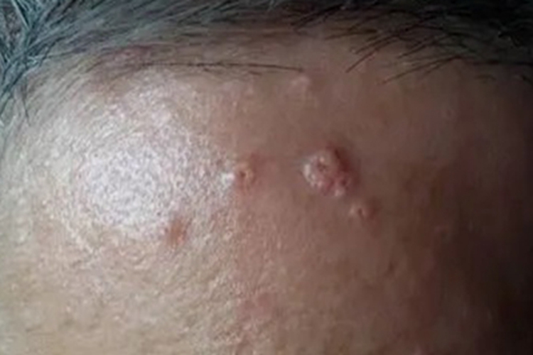 老年性皮脂腺增生圆疙瘩图 老年性皮脂腺增生圆疙瘩图