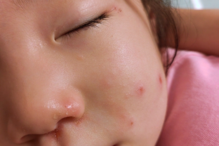 水痘小孩面部出现红斑图