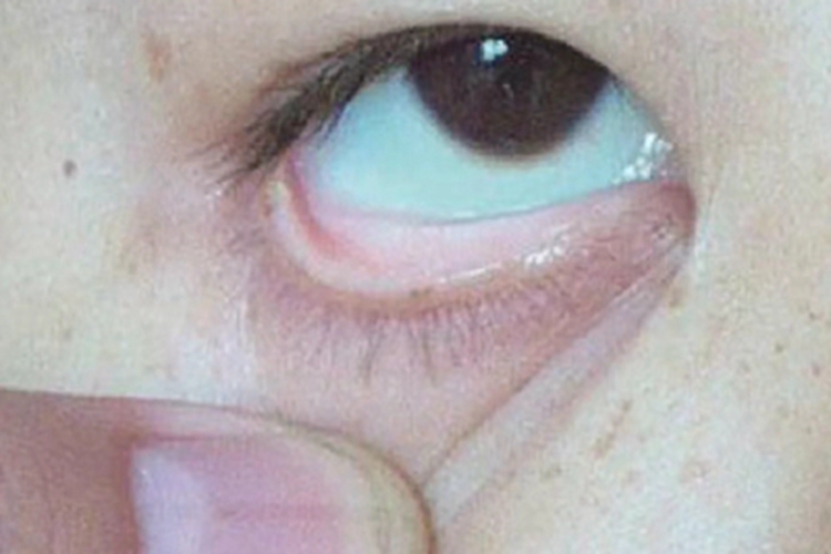 慢性苯中毒眼睑发白图 慢性苯中毒眼睑发白图