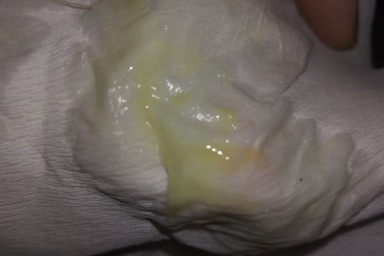 大量阴道分泌物图 大量阴道分泌物图