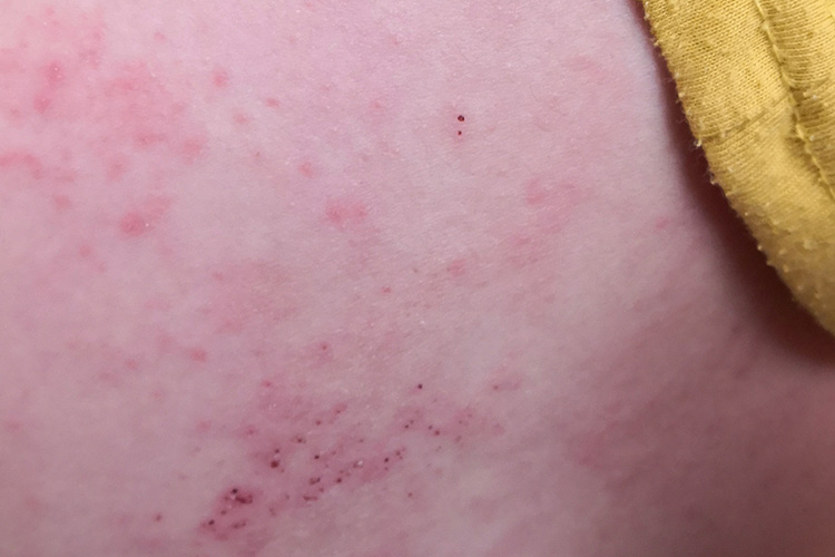 顿挫性带状疱疹图