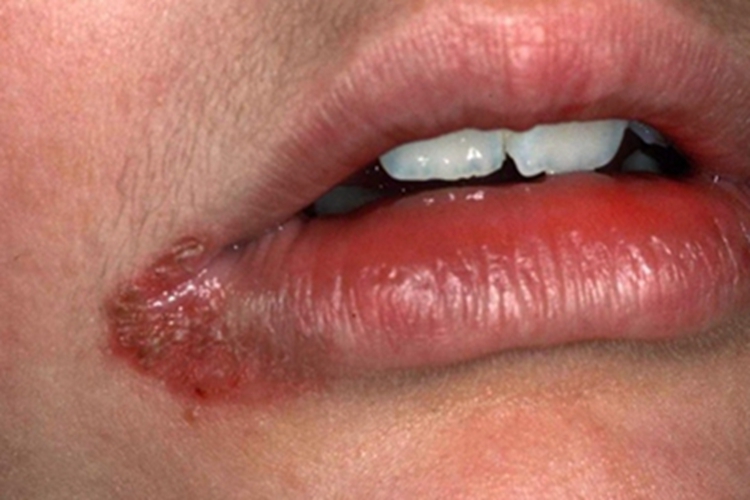 创伤性口角炎口角结痂图