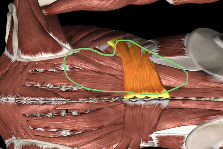 筋膜炎位置示意图