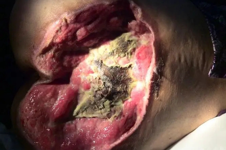 坏死溃疡期褥疮图