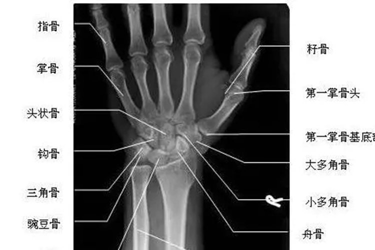 腕关节正位片图 腕关节正位片图