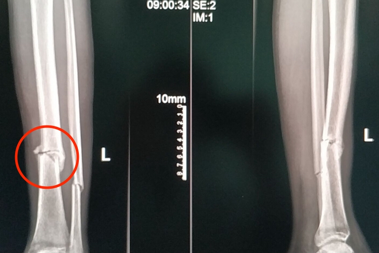 胫腓骨全断骨痂图 胫腓骨全断骨痂图