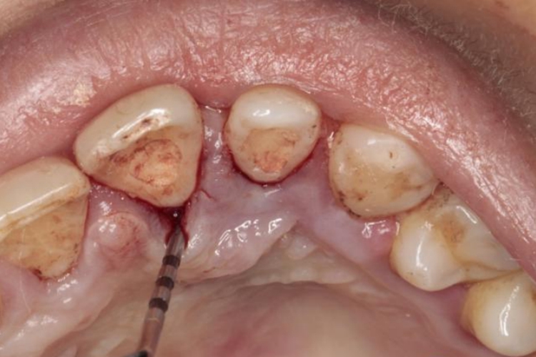 轻度牙周袋图 轻度牙周袋图