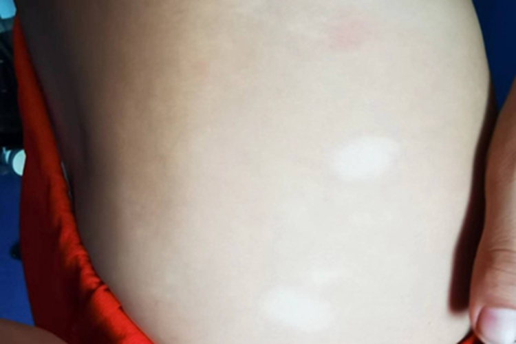 白癜风臀部白斑图