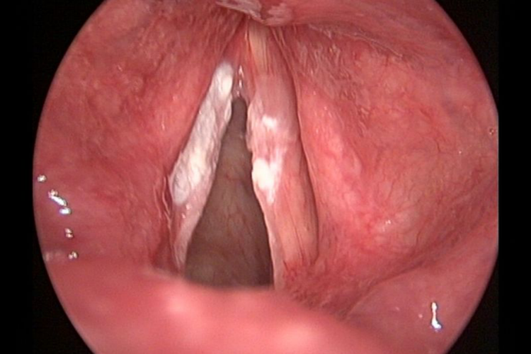 喉咙白斑早期图