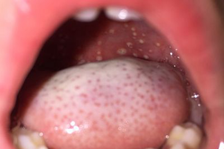 疱疹性咽峡炎咽峡小水疱图