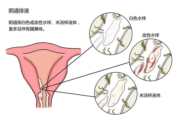 如何判断早期宫颈癌