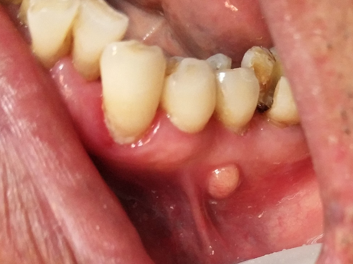 牙疼牙龈长脓包警惕慢性根尖牙周炎
