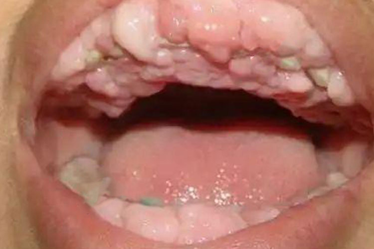 牙龈癌肿瘤图 牙龈癌肿瘤图