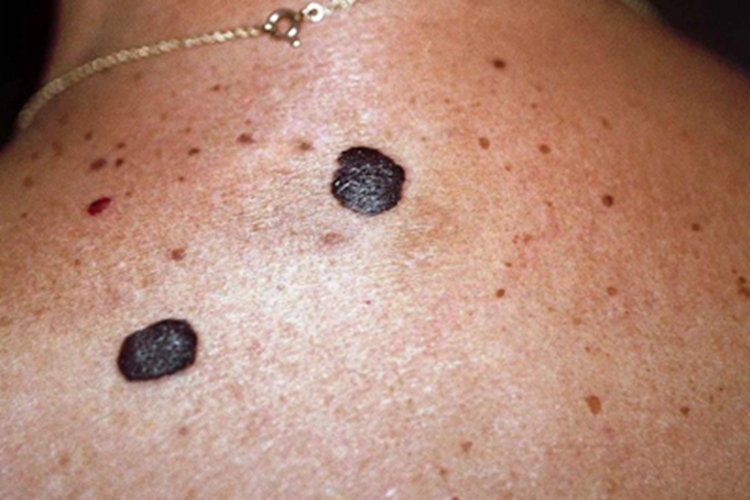 脂溢性角化病背部疙瘩图 脂溢性角化病背部疙瘩图