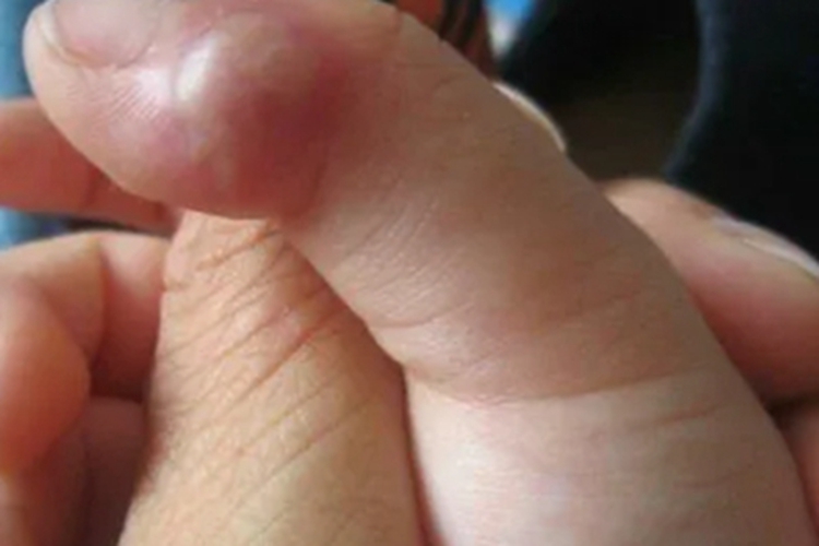 幼年型类天疱疮手指症状图