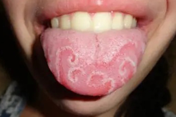 舌苔有一块一块的空缺图 舌苔有一块一块的空缺图