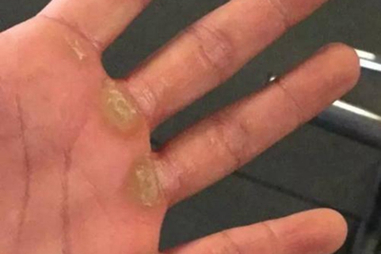 胼胝手掌黄色硬皮图 胼胝手掌黄色硬皮图