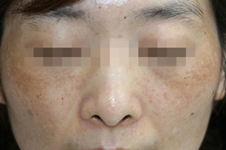 黄褐斑眼周症状图