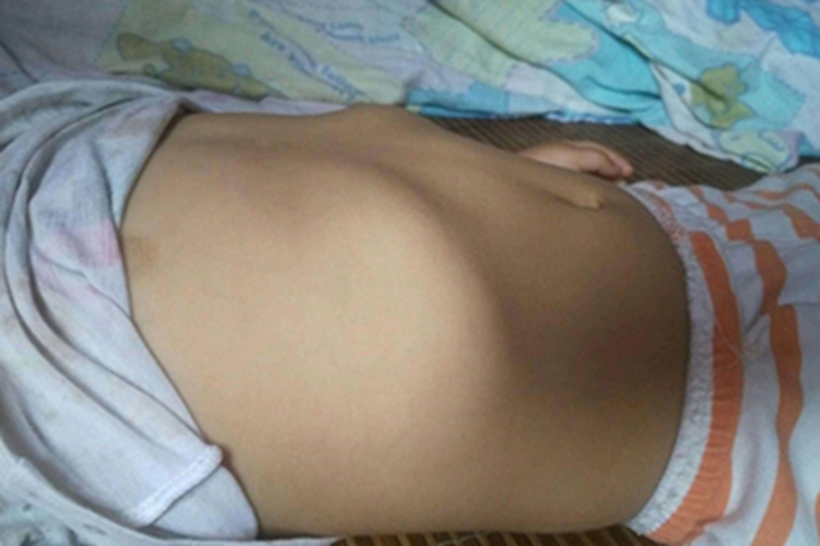 维生素D缺乏性佝偻病症状图 维生素D缺乏性佝偻病症状图