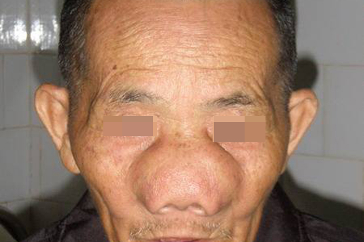 鼻息肉鼻梁两侧肉鼓起图 鼻息肉鼻梁两侧肉鼓起图